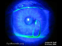 corneal perforation, seidel positive