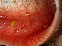 Chlamydia trachomatis infection