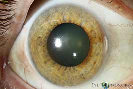 Cornea and lens staining by Thoorazine