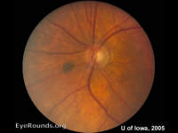 Choroidal Nevus