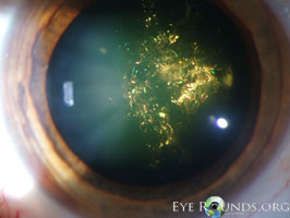 Christmas tree cataract