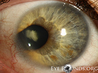 Coloboma: Temporal iris and lens coloboma associated with cataract