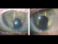 coloboma, Iris
