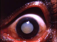 Hypermature cataract