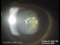 Congenital Cataract--Sutural
