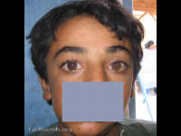 Congenital Glaucoma