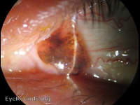conjunctival nevus