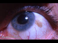 bulbar conjunctival nevus