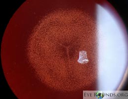 Coppock cataract