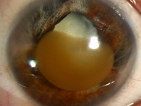 Corneal Blood Staining