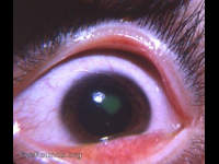 contact lens overwear reaction