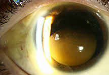 Corneal Blood Staining
