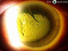thermal corneal burn