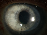 Descemet Membrane Automated Endothelial Keratoplasty (DMAEK)