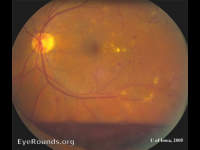 diabetic retinopathy