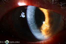 Interface haze following Descemet's Stripping Automated Endothelial Keratoplasty (DSAEK)