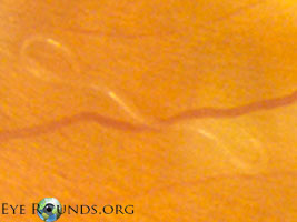 Diffuse Unilateral Subacute Neuroretinitis (DUSN)
