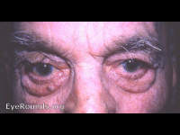 dermatochalasis with papillomata