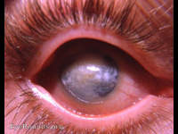 diffuse calcareous keratopathy