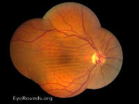choroidal folds