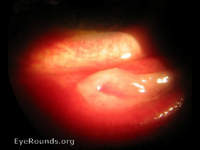 Epidemic Keratoconjunctivitis