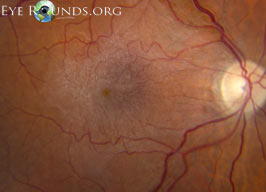 Epiretinal membrane