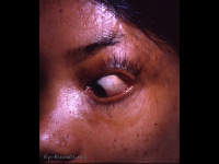 Cicatricial ectropin from burns sustained by Nepalese girl
