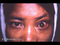 ectropion of lids OS from scarring due to lid burns