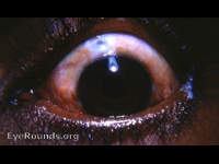 Elliott trephine operation with usual filtering cystoid bleb