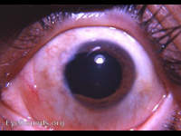 prolapsed iris following intracapsular cataract surgery