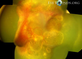 Familial Exudative Vitreoretinopathy (FEVR)