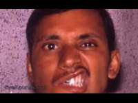 Right facial nerve paresis