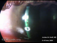 Ferrous foreign body--Rust ring
