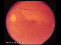 BRAO due to fibrin embolus