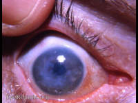 Fuchs epithelial-endothelial corneal dystrophy