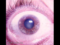 Fuchs' heterochromic cyclitis