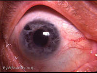 Fuchs' heterochromic cyclitis - post-op aphakia