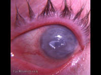 Fuchs epithelial-endothelial corneal dystrophy with central ruptured epithelial bullae