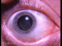 Cataract with Fuchs' heterochromic cyclitis