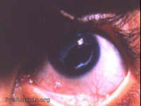 Extracapsular cataract in a child: the use of the Fuchs' syringe