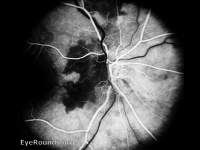 Giant Cell Arteritis (Temporal Arteritis) - GCA