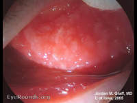 Giant Papillary Conjunctivitis