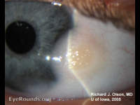 Goldenhar's Syndrome