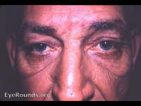 Groenblad-Stranberg syndrome: pseudoxanthoma elastcum with andioid streaks of the fundus oculi