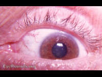 Groenouw's Type I Granular corneal dystrophy
