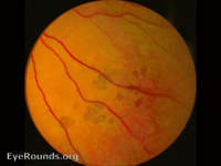 Grouped Pigmentation