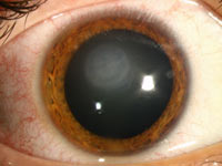 HSV disciform keratopathy