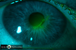 HSV epithelial keratitis
