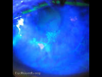 herpes simplex virus (keratitis)