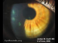 Herpes simplex virus keratitis